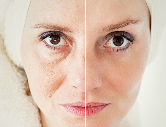 Half-face comparison showing visible improvement in skin tone and texture before and after treatment at DHL Skin Centre in Vijay Nagar Indore