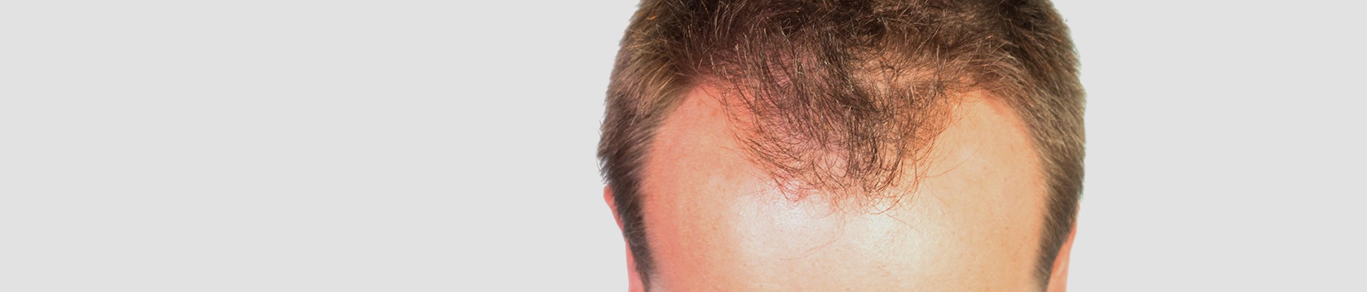 Top of a man's head showing hair thinning and receding hairline, representing hair loss treatment at DHL Skin Centre in Vijay Nagar Indore