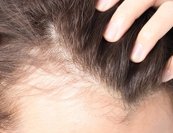 Scalp with noticeable hair thinning and receding hairline, evaluated for hair loss treatment at DHL Skin Centre in Vijay Nagar Indore
