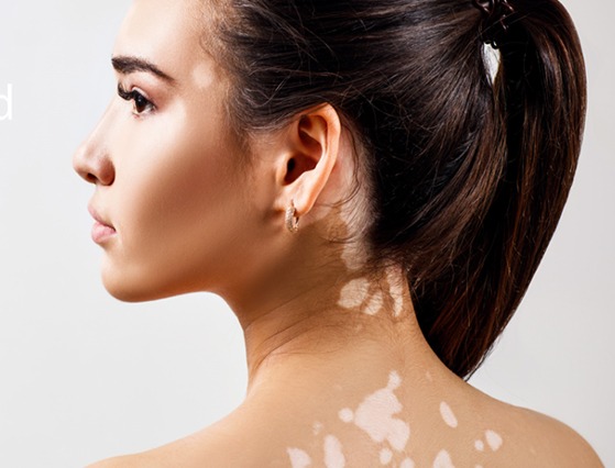 Woman with vitiligo patches on neck and upper back, highlighting skin condition treated at DHL Skin Centre in Vijay Nagar Indore