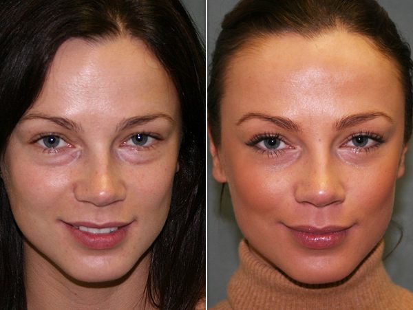 Before-and-after facial comparison showing a woman with visible under-eye concerns in the first image and a smoother, more refreshed-looking appearance in the second image.